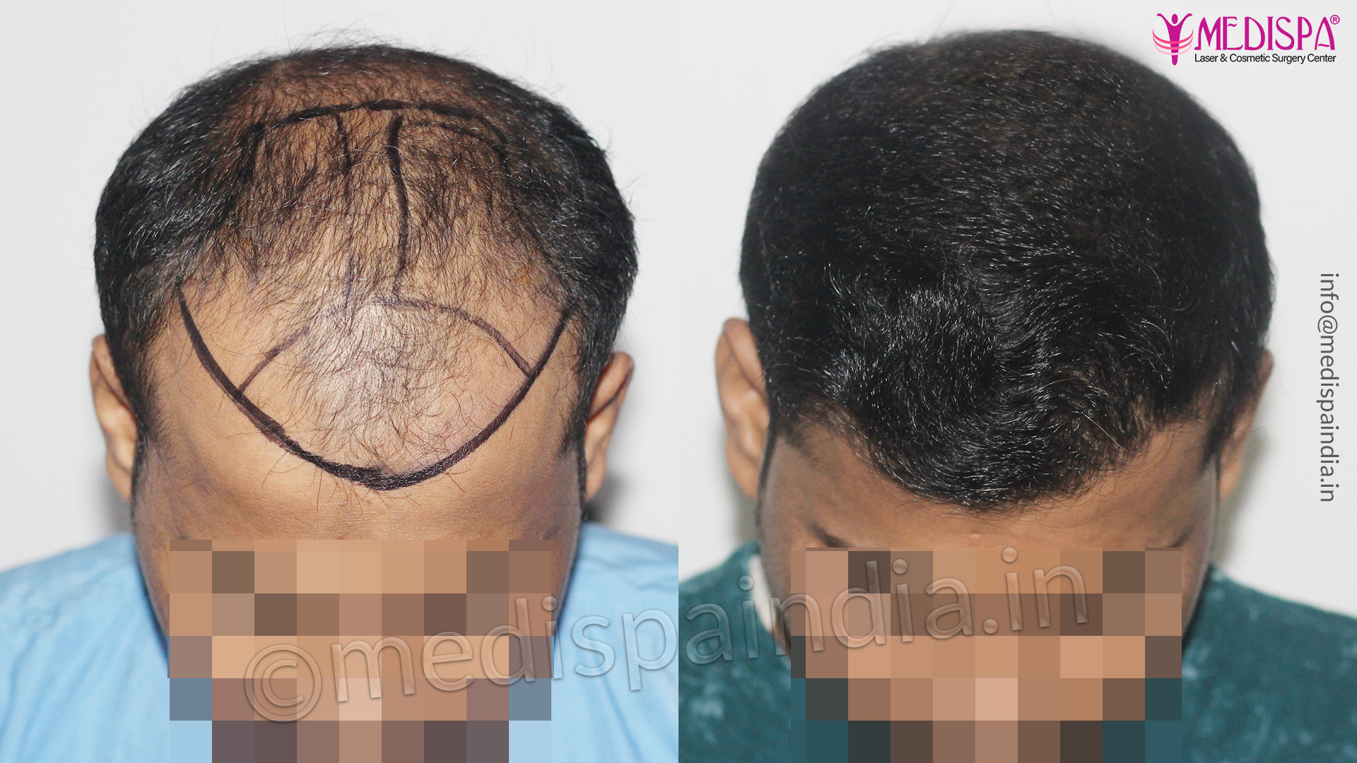 V Plant Advanced hair clinicHair transplantPRPHair loss treatment
